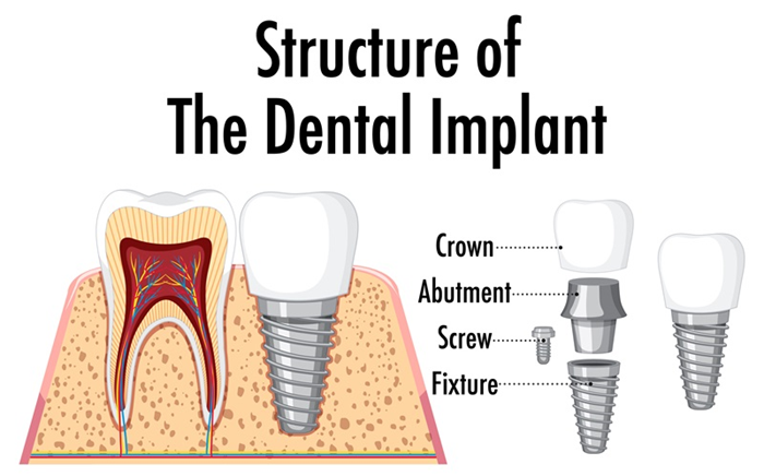 dental implants