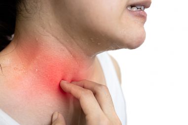 How to Beat Heat Rash This Summer